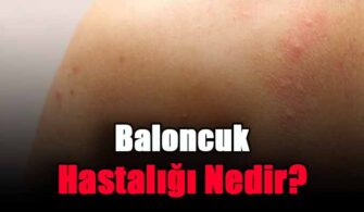 Baloncuk Hastalığı Nedir?