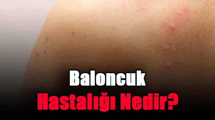 Baloncuk Hastalığı Nedir?