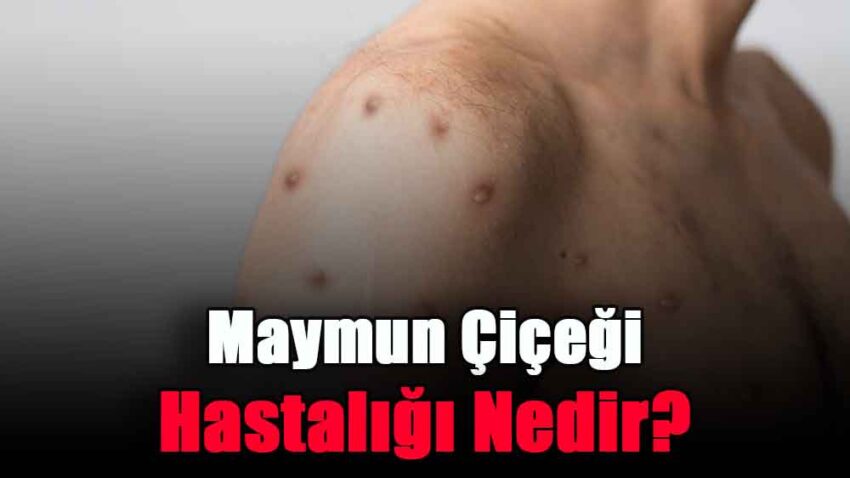 Maymun Çiçeği Hastalığı Nedir?