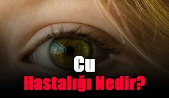 cu-hastaligi-nedir