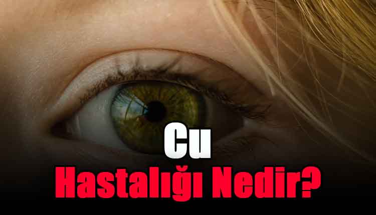 Cu Hastalığı Nedir?