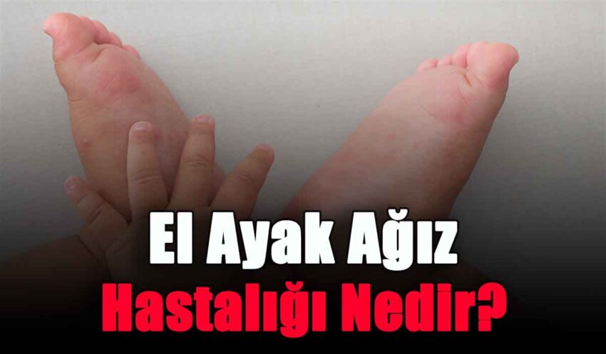 El Ayak Ağız Hastalığı Nedir?
