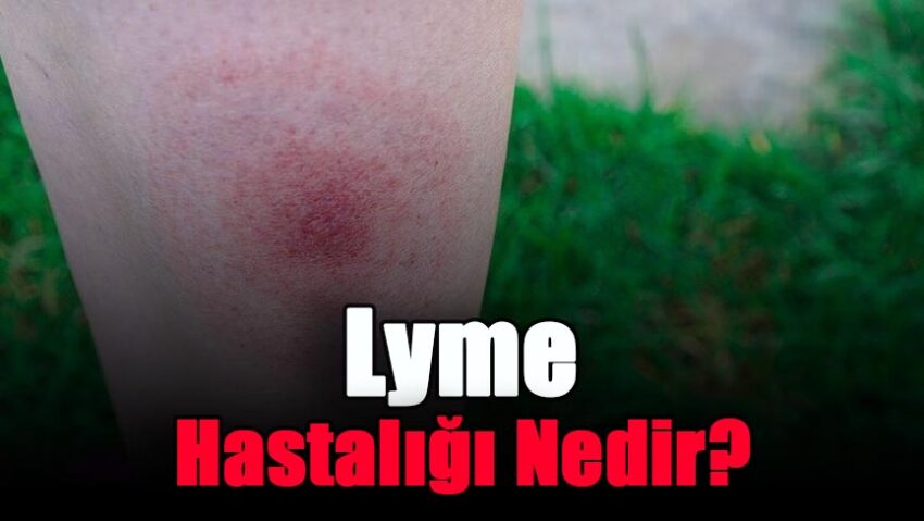 Lyme Hastalığı Nedir?