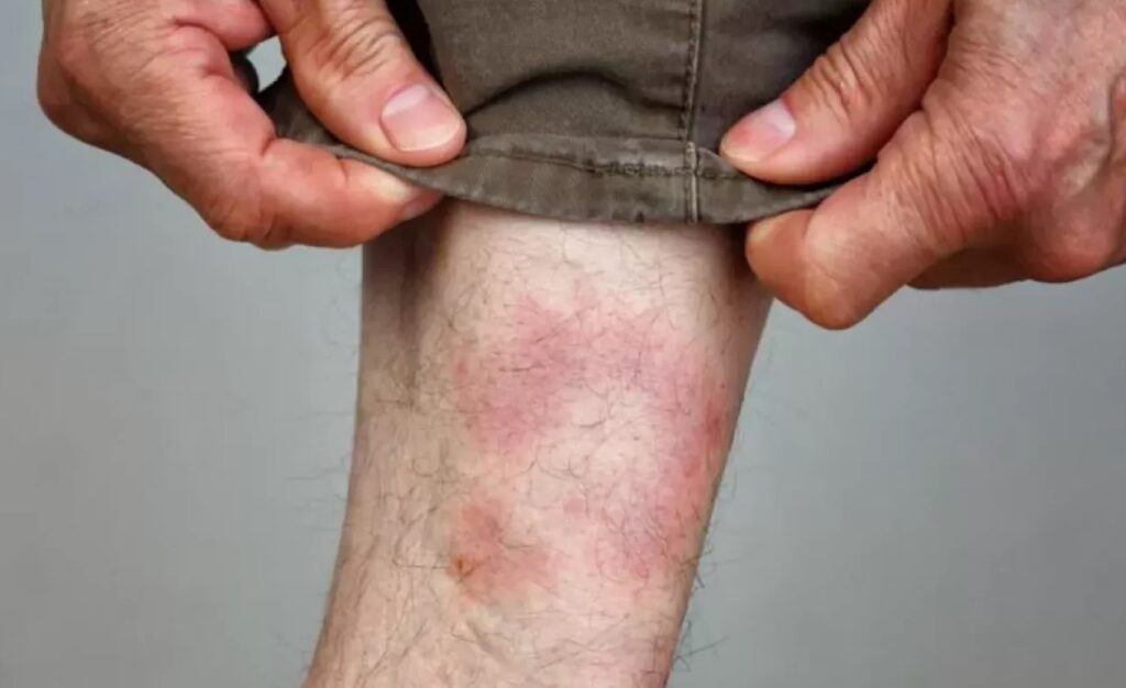 Lyme Hastalığının Tedavi Yöntemleri Nelerdir?