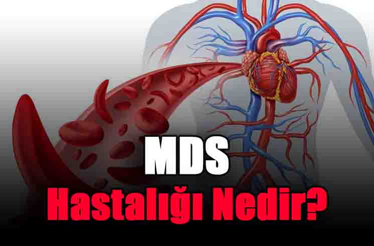 MDS Hastalığı Nedir?