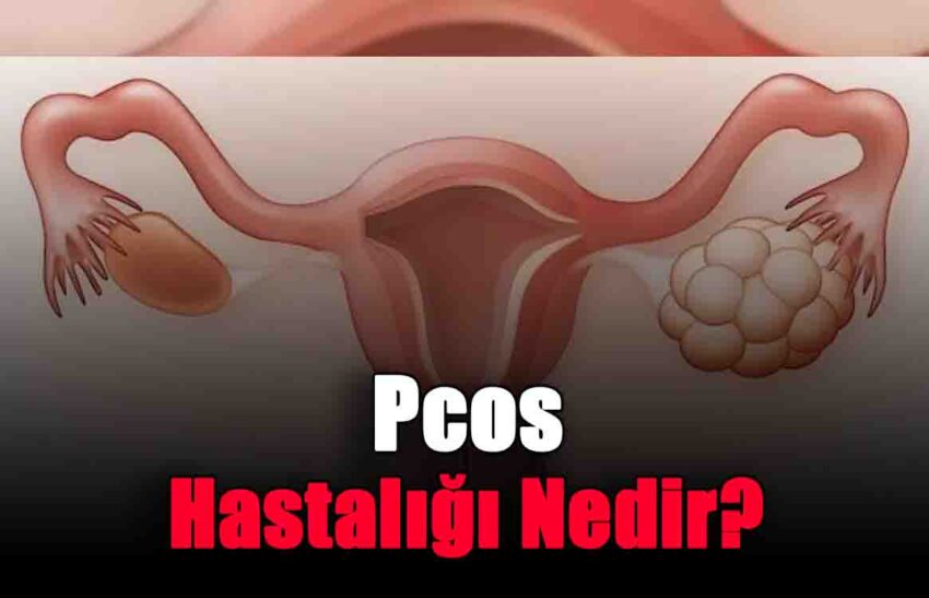 Pcos Hastalığı Nedir?