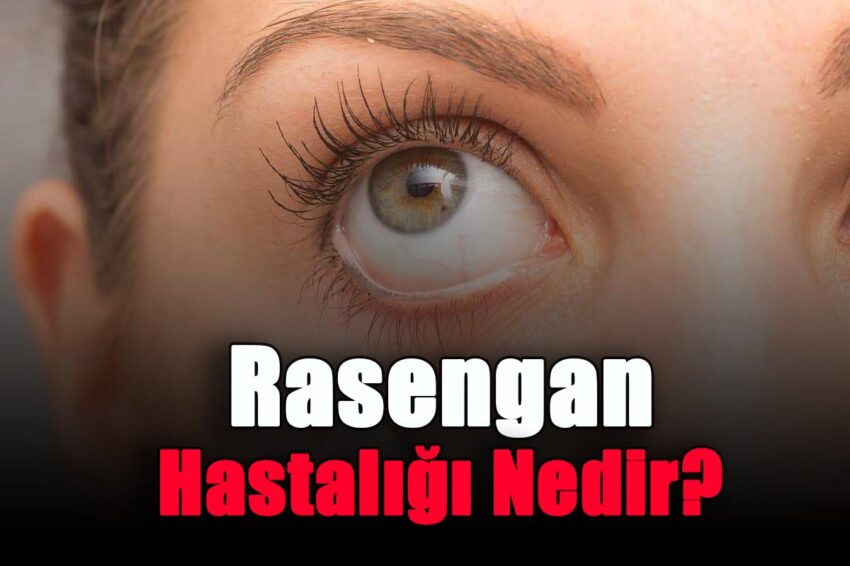 Rasengan Hastalığı Nedir?