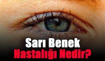 Sarı Benek Hastalığı Nedir?
