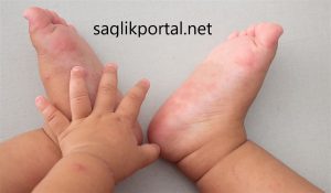 El Ayak Ağız Hastalığı