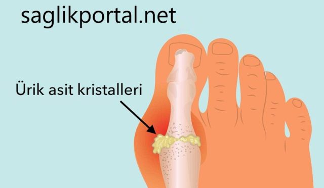 Gut Hastalığı Nedir?