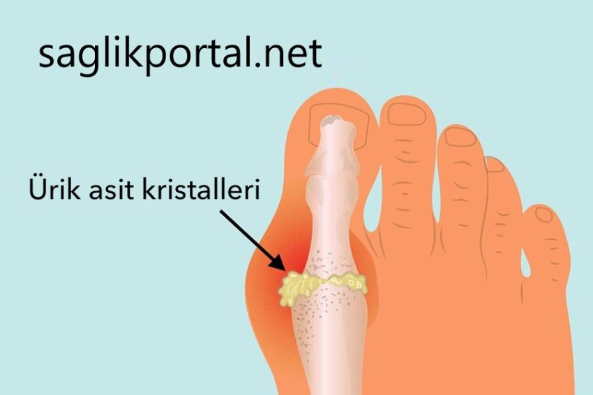 Gut Hastalığı Nedir?