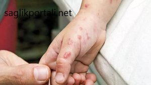 Maymun Çiçeği Hastalığı Nedir?