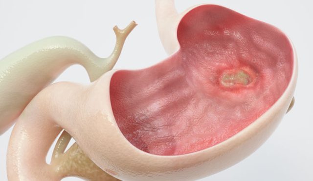Mide ülseri nedir?